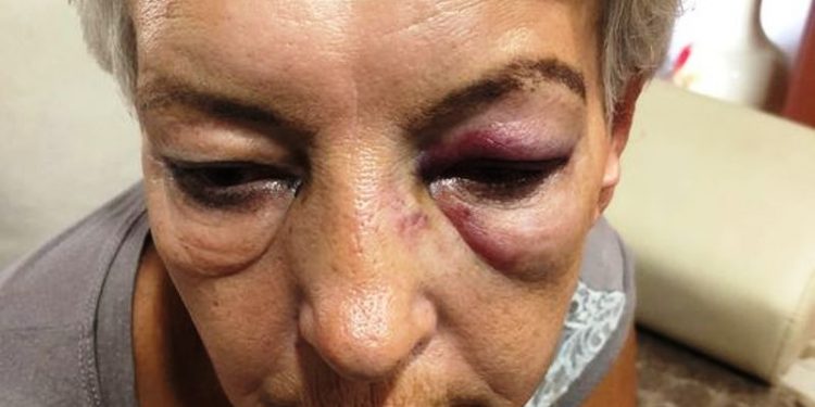 “Stop nasilju nad ženama”: Napadnuti penzionosani major policije u Novom Pazaru poziva na protest i traži pravdu
