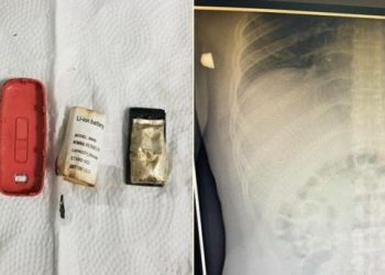 Pacijentu iz stomaka izvadili mobitel: “Baterija je mogla eksplodirati”