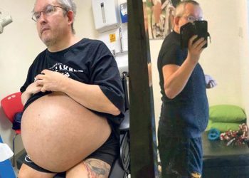OPERISALI GA DVA SATA: Britancu izvadili bubrege teške čak 35 kilograma!