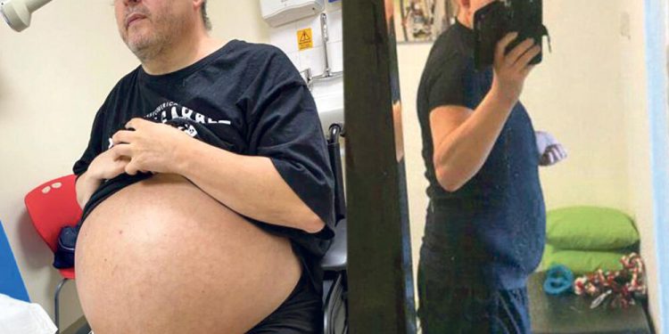 OPERISALI GA DVA SATA: Britancu izvadili bubrege teške čak 35 kilograma!